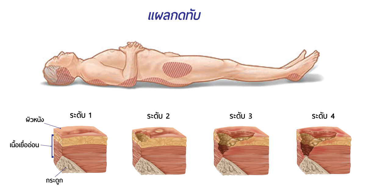 แผลกดทับ