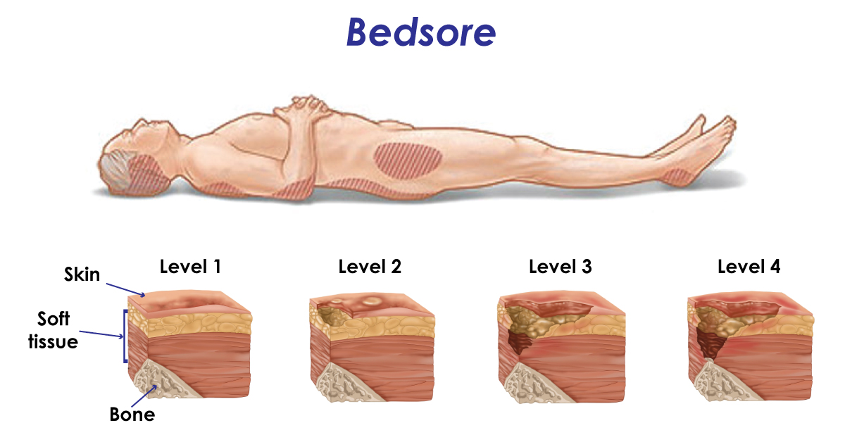 Bedsores are classified into 4 grades