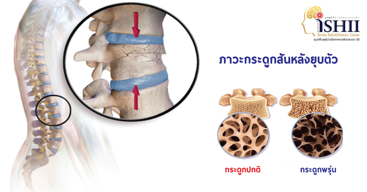 ภาวะกระดูกสันหลังยุบตัว