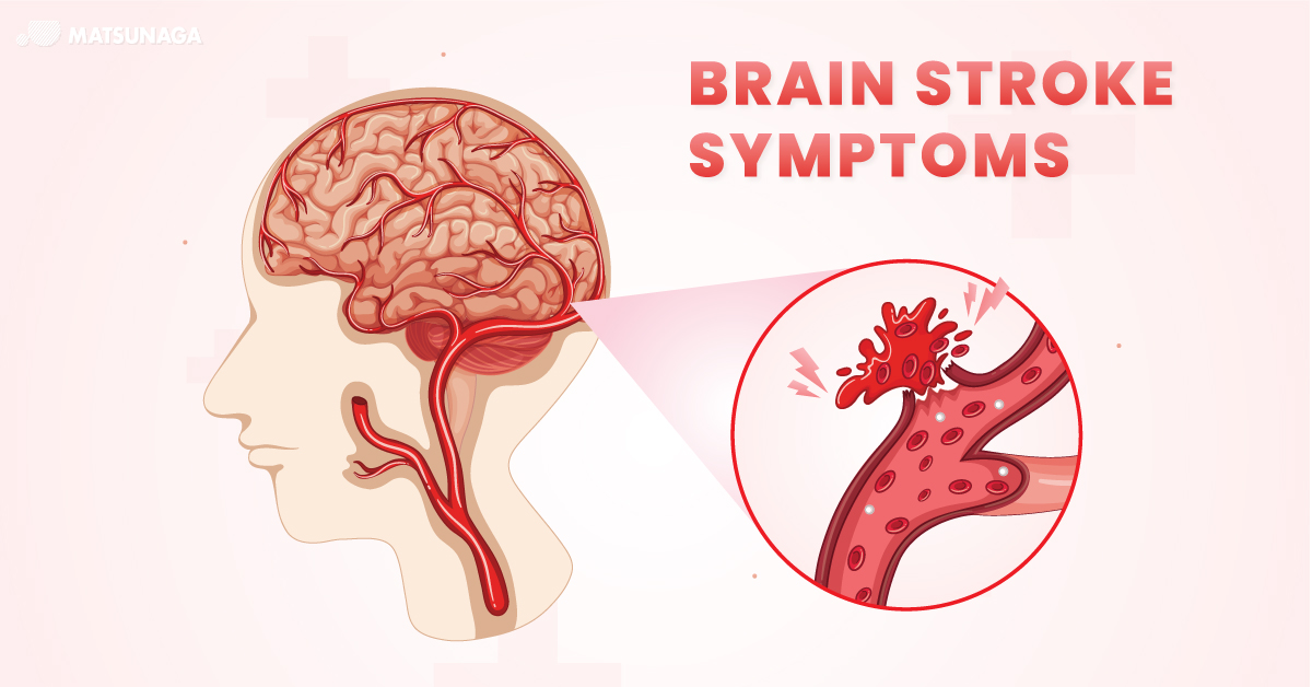 โรคหลอดเลือดสมอง Stroke