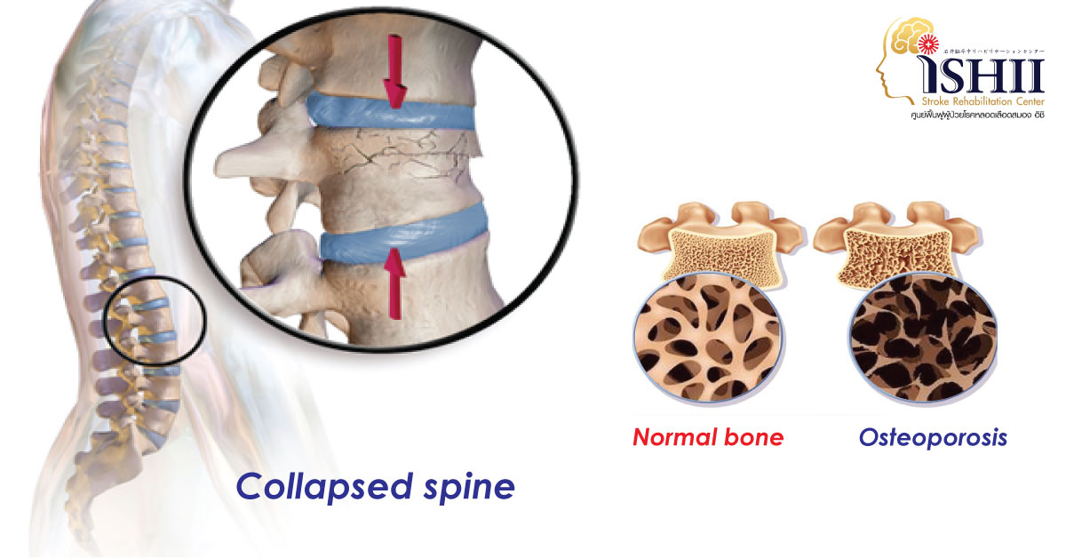 Collapsed spine